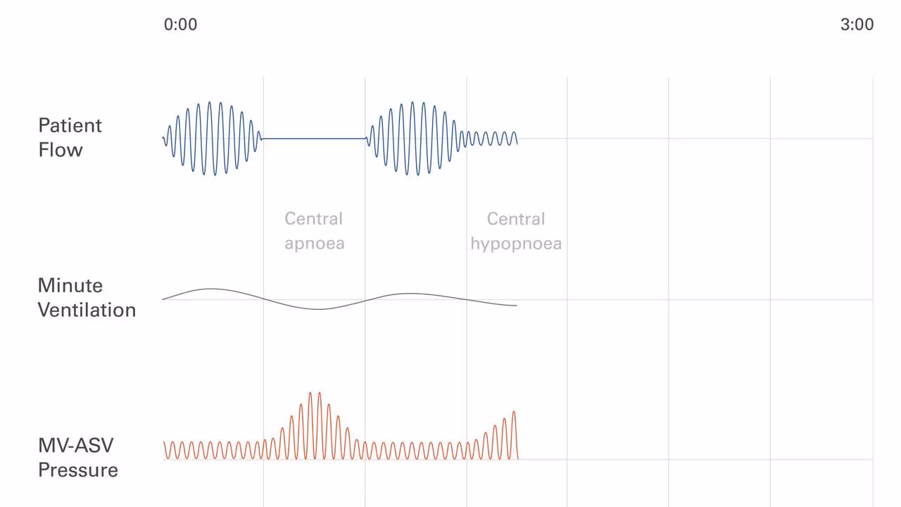 ASV-Period-breathing-alorithm-1