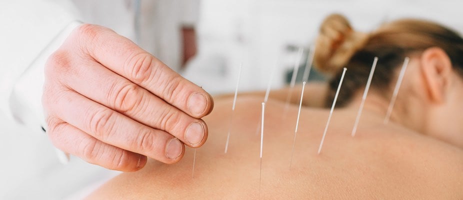 acupuncture